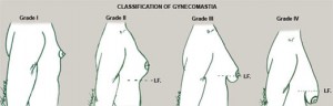 ginecomastia-1